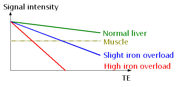 Iron overload and signal intensity